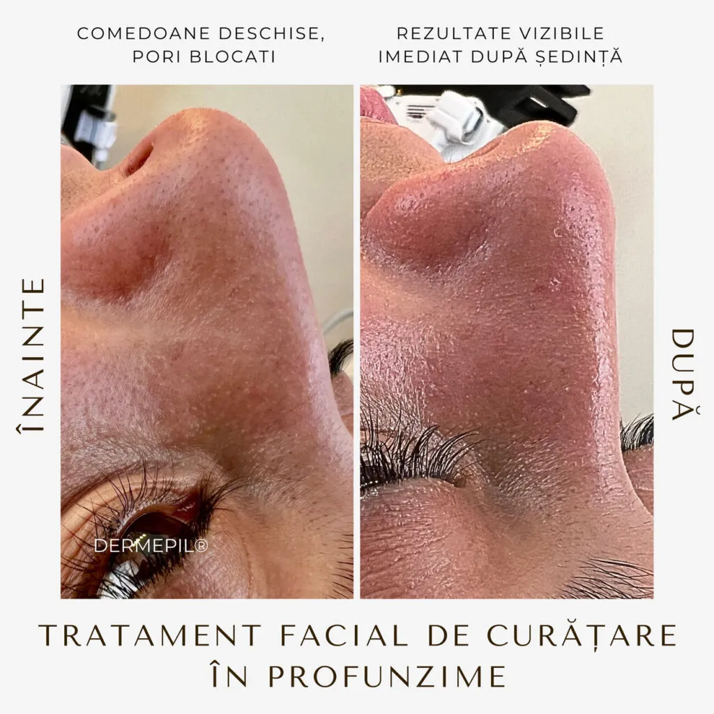 tratament facial curatare 10