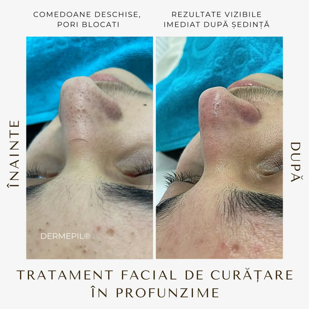 tratament facial curatare 11
