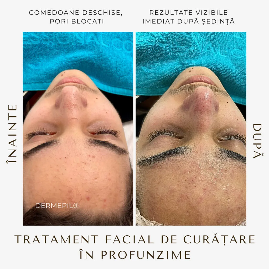 tratament facial curatare 12.png