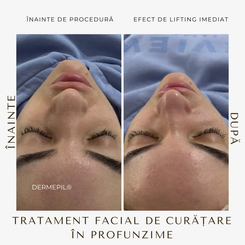tratament facial curatare 4.png