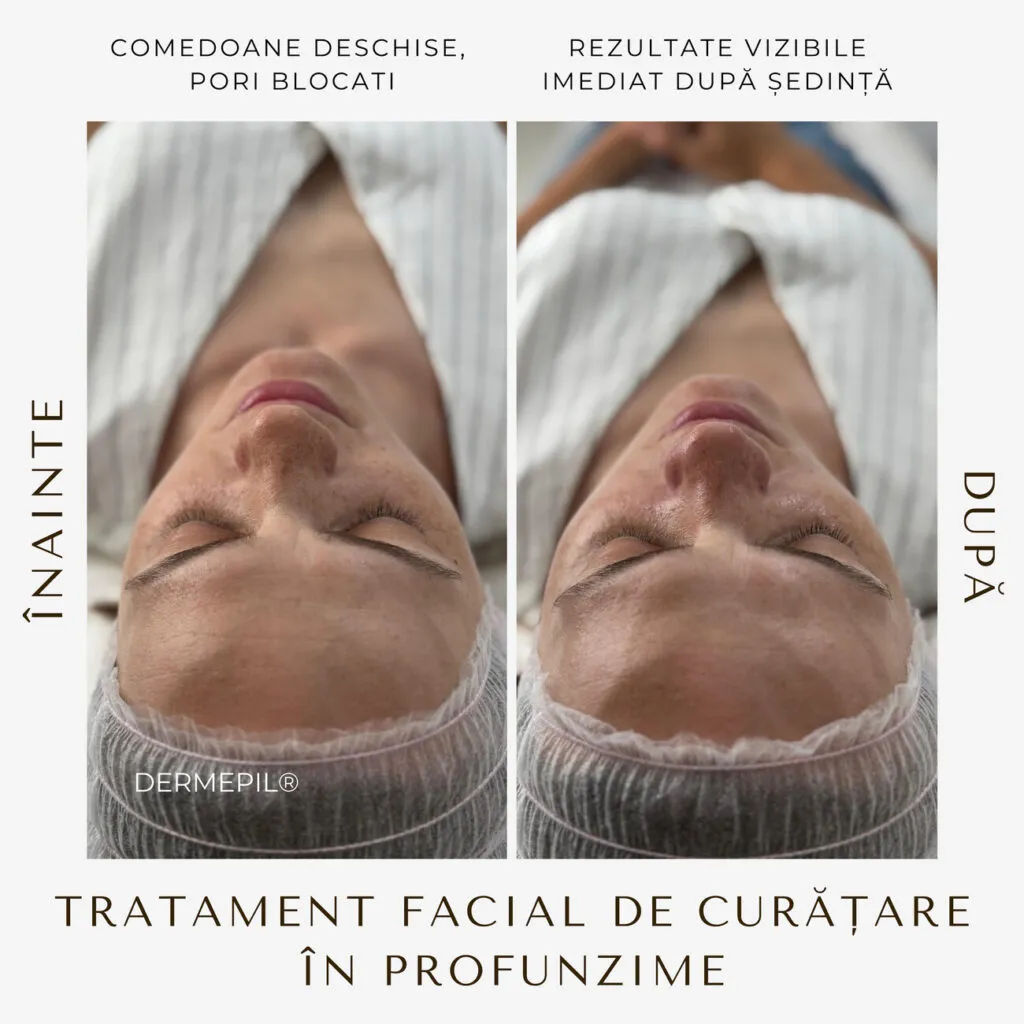 tratament facial curatare 5