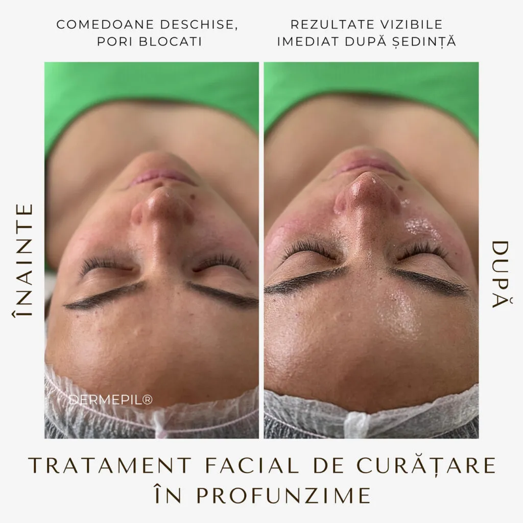 tratament facial curatare 8