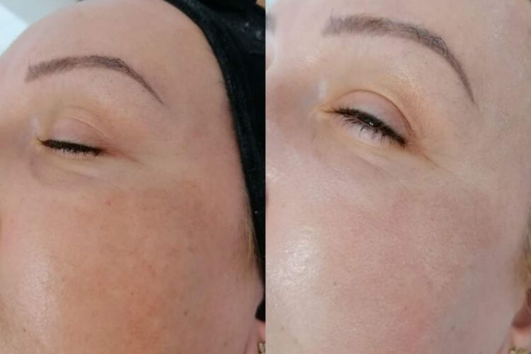 Pachet 6 sedinte Rejuvenare Faciala cu Laser Dioda