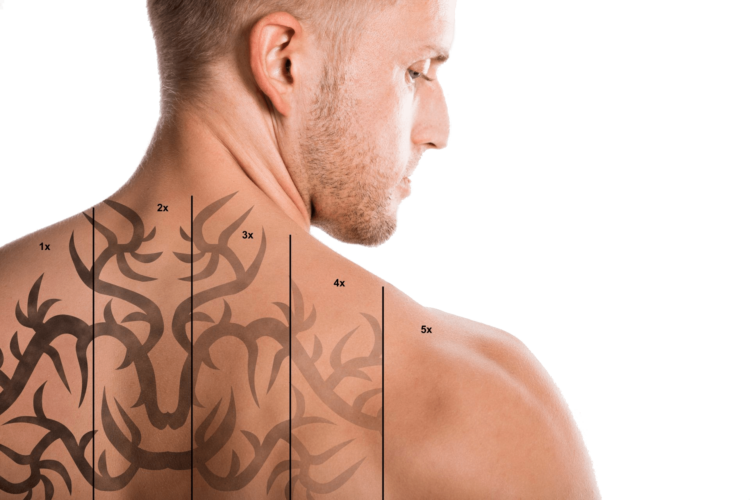 Indepartare tatuaj cu laser