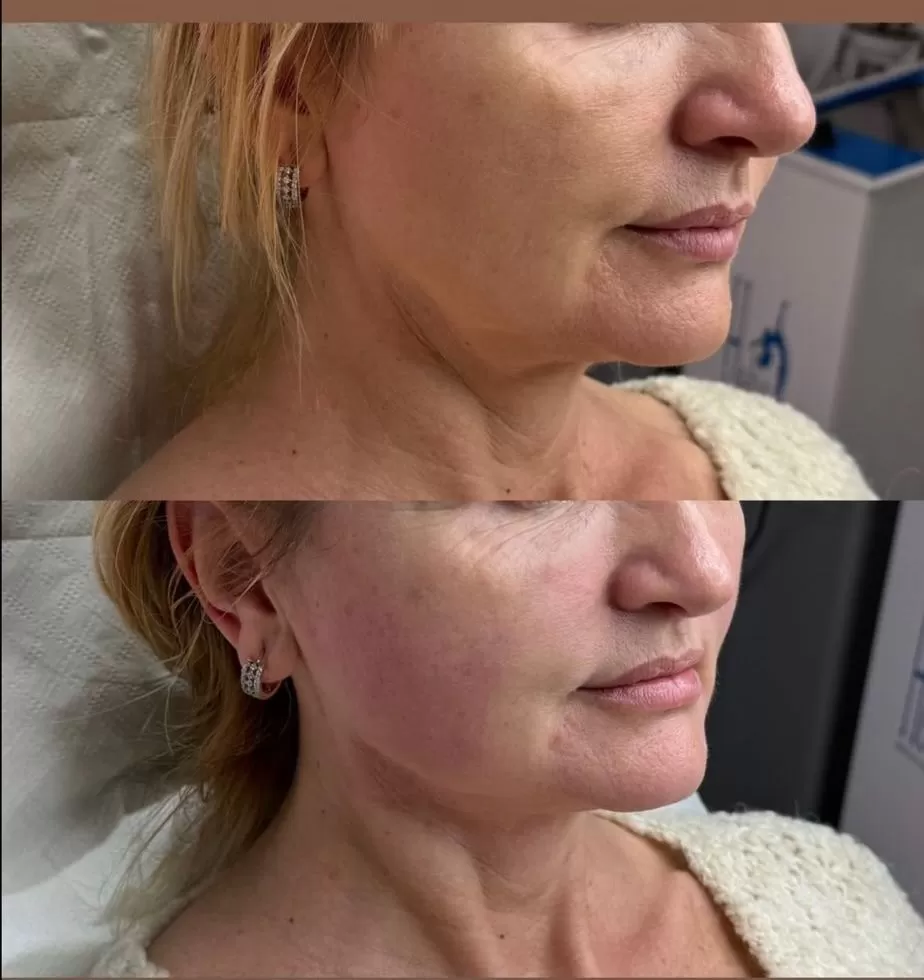 HiFU Gușă - imagine 3