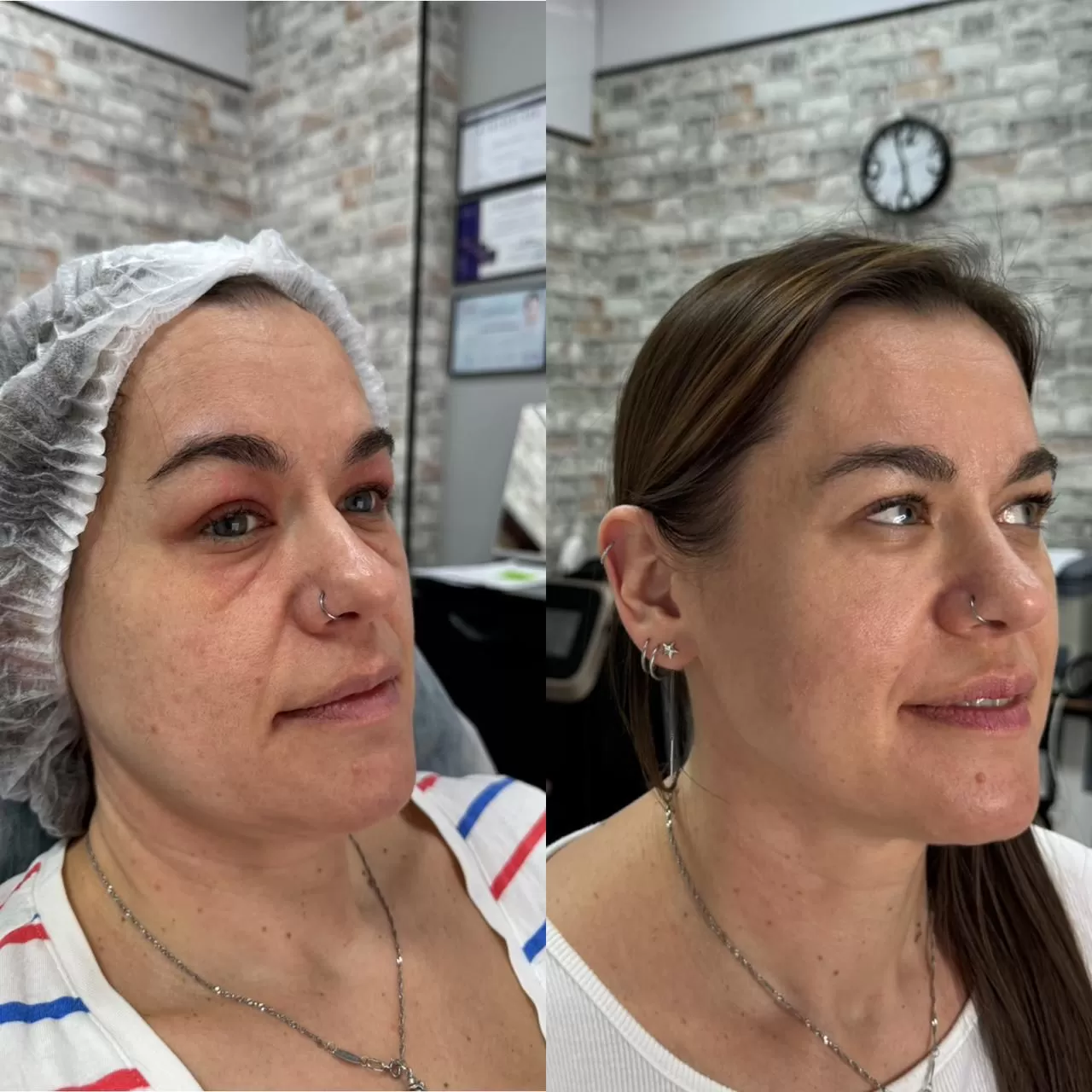 HiFU Gușă - imagine 4