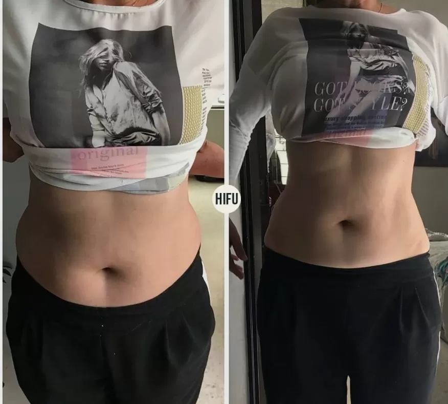 HiFU/Liposonix Coapse interior - imagine 4