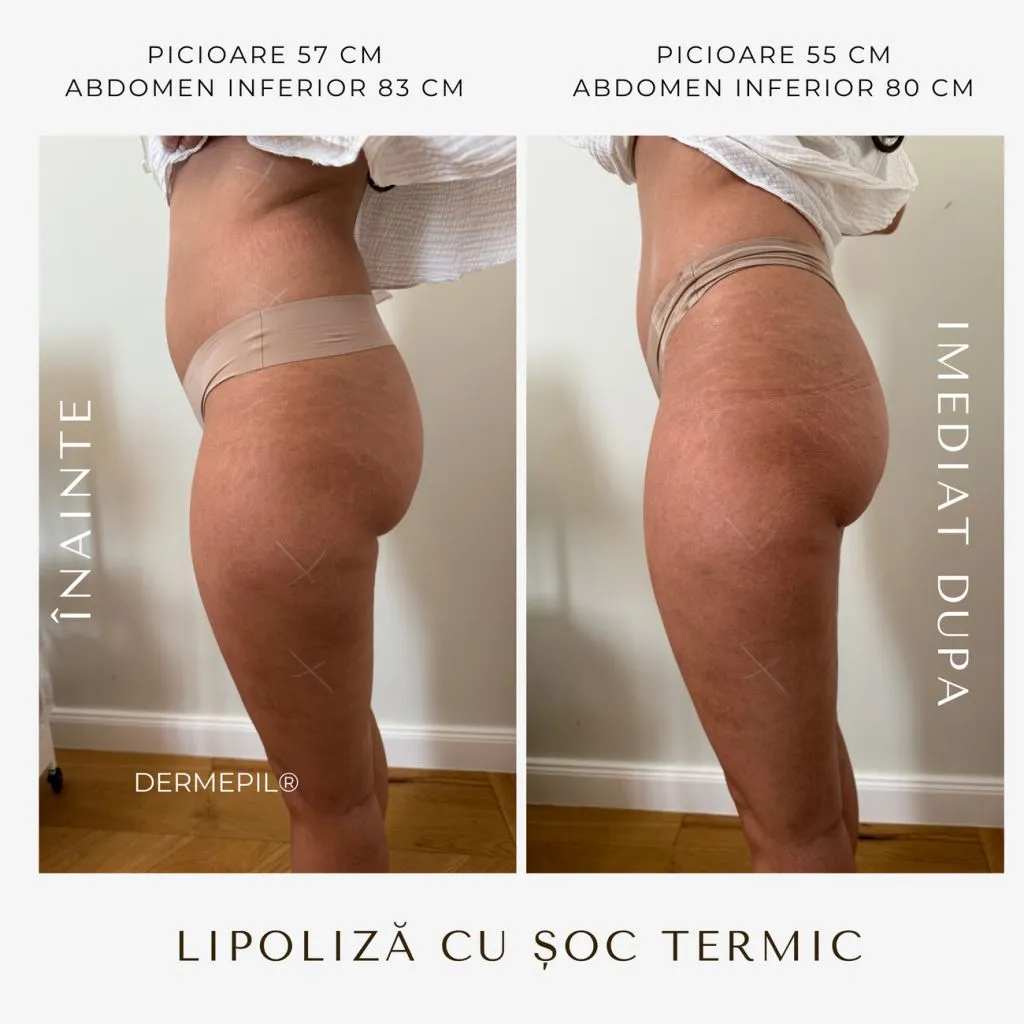 criolipoliza before after 1.png