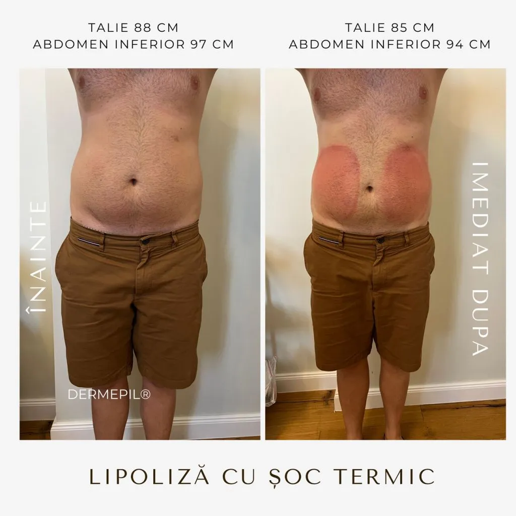 criolipoliza before after 2.png
