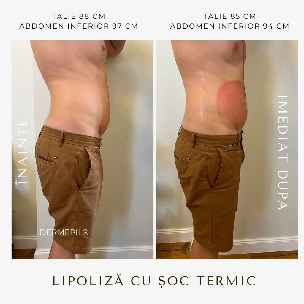criolipoliza before after 3.png