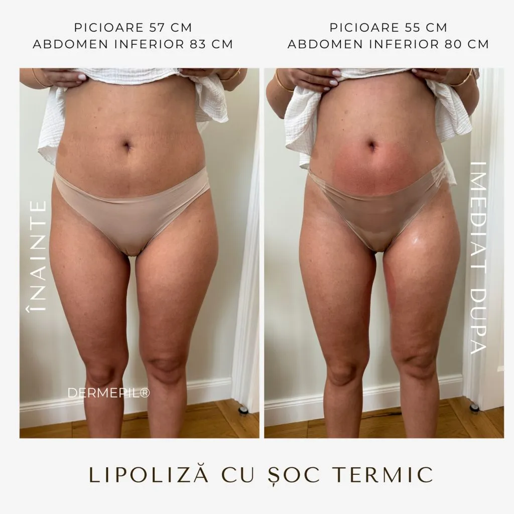 criolipoliza before after 4.png