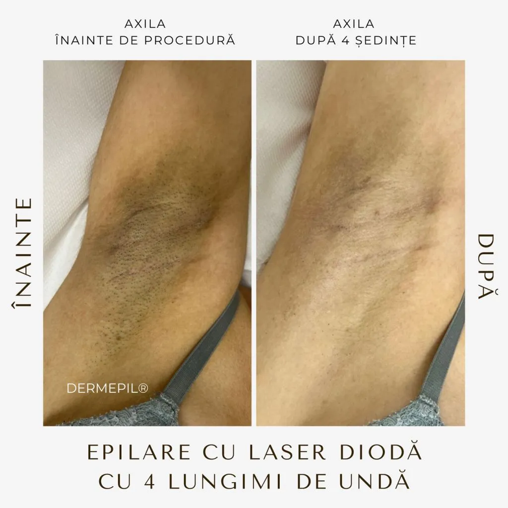 epilare-definitiva-before-and-after-1.png.jpg