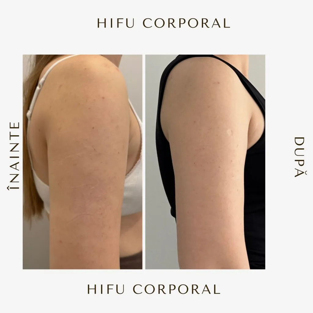 hifu-before-and-after-14.jpg