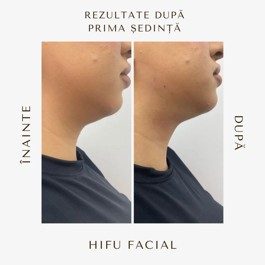 hifu-before-and-after-17.jpg