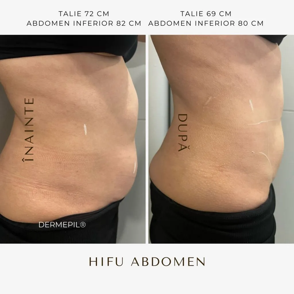 hifu-before-and-after-27.png.jpg