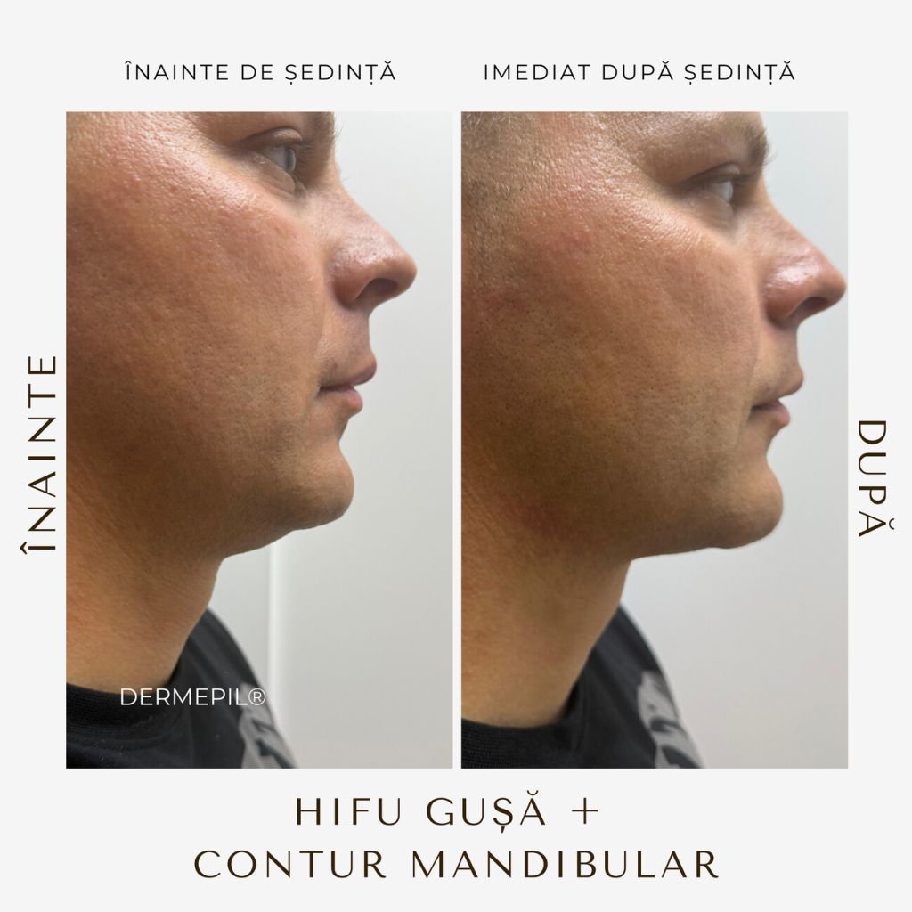 hifu-before-and-after-3.png.jpg