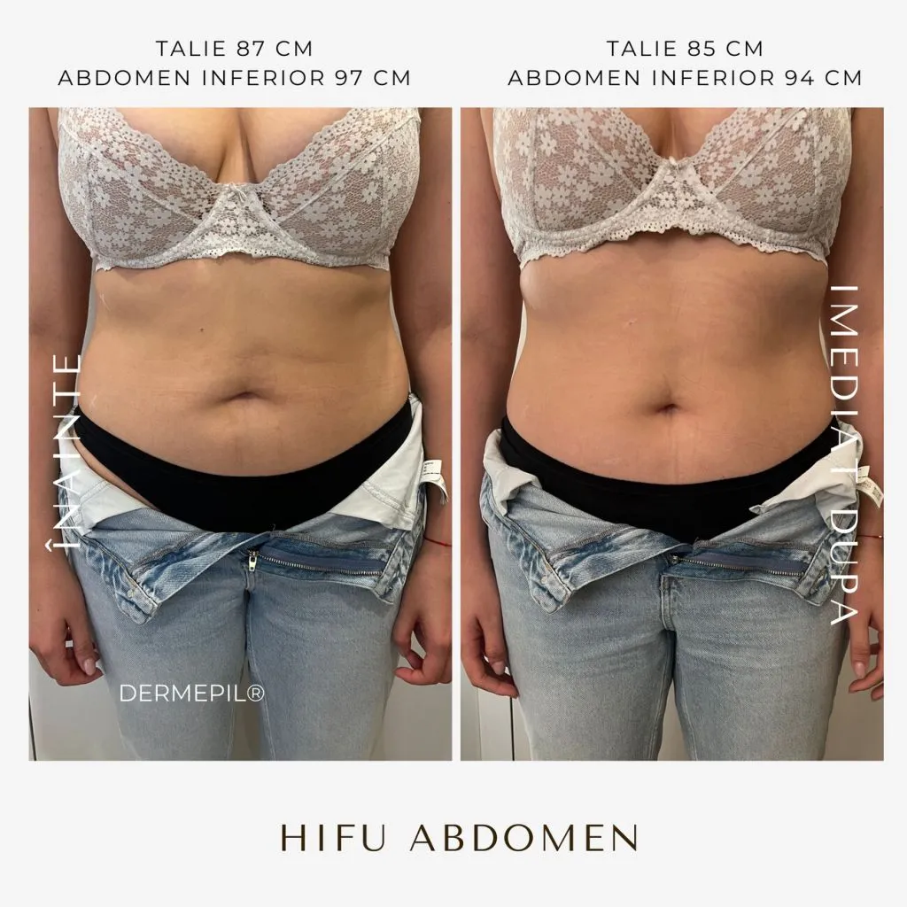 hifu-before-and-after-8.png.jpg