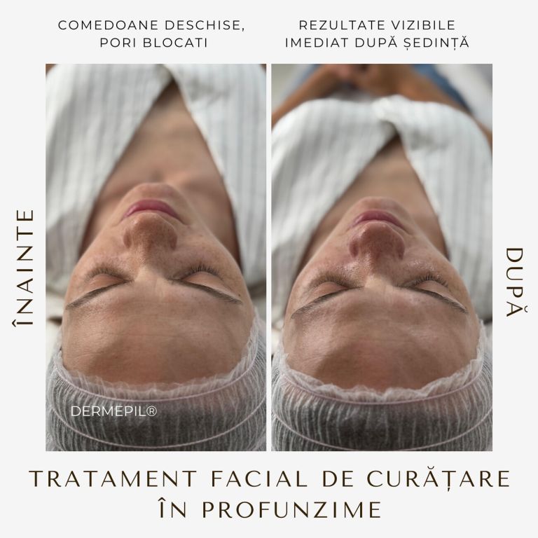 tratament-facial-curatare-5.jpg
