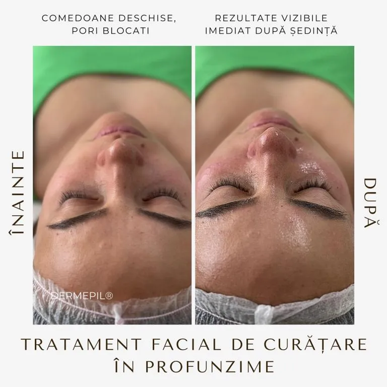 tratament-facial-curatare-8.jpg