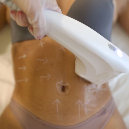 Black Friday Abonament 3 Sedinte HiFU-Abdomen