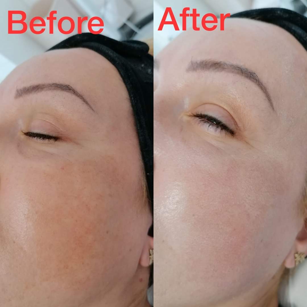 Rejuvenare Facială cu Laser Dioda