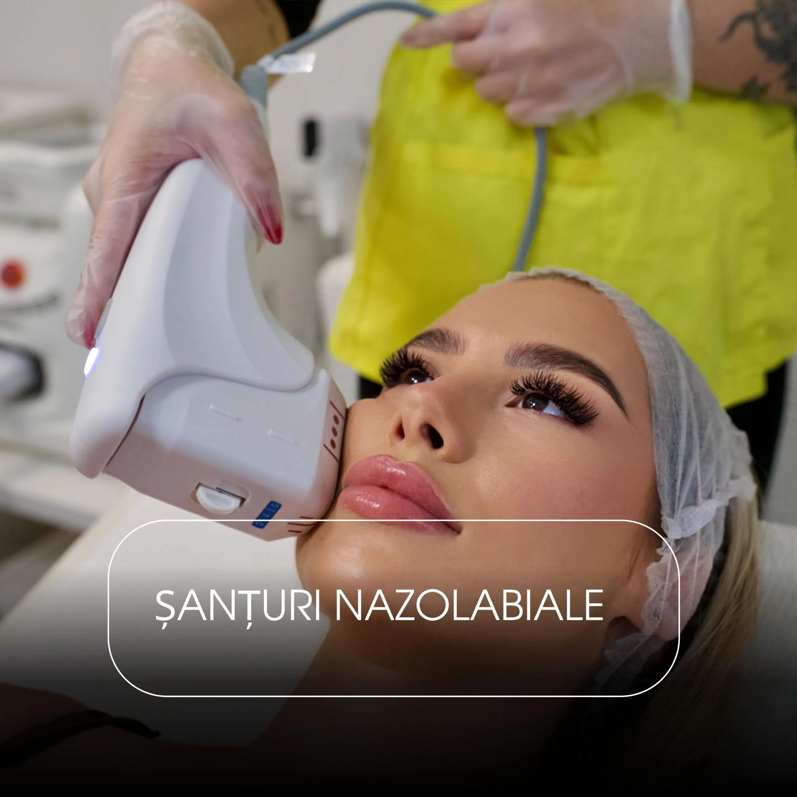 HiFu Șanțuri nazolabiale