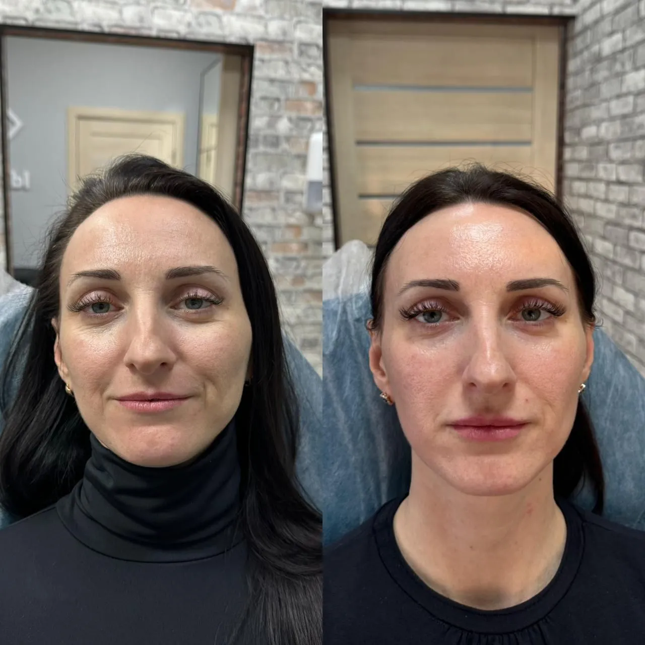 HiFu_facial_Inainte_Dupa