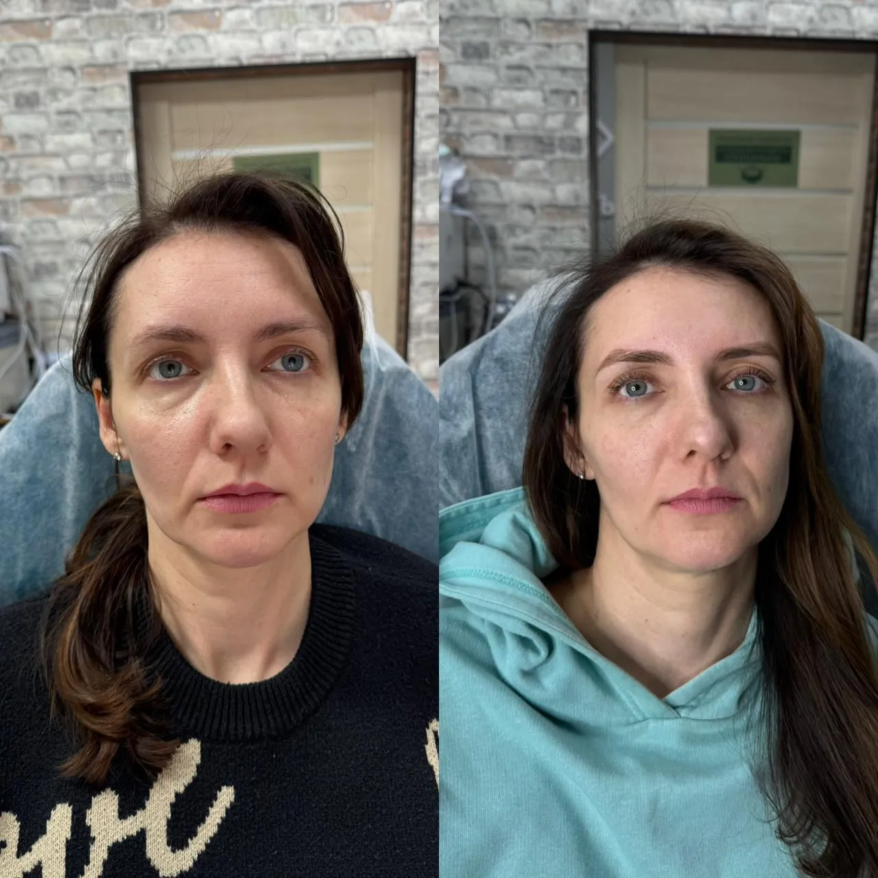 Hifu-Facial-Inainte-Si-Dupa