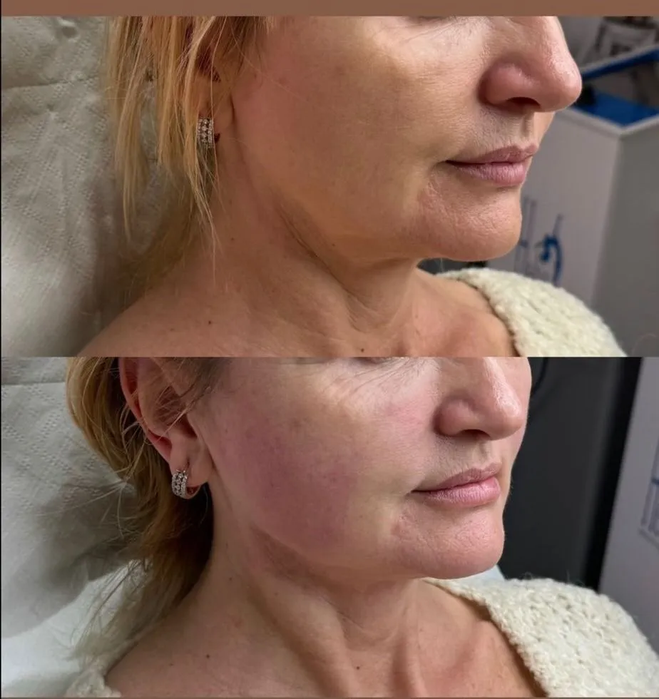 Hifu-Facial_Before_After