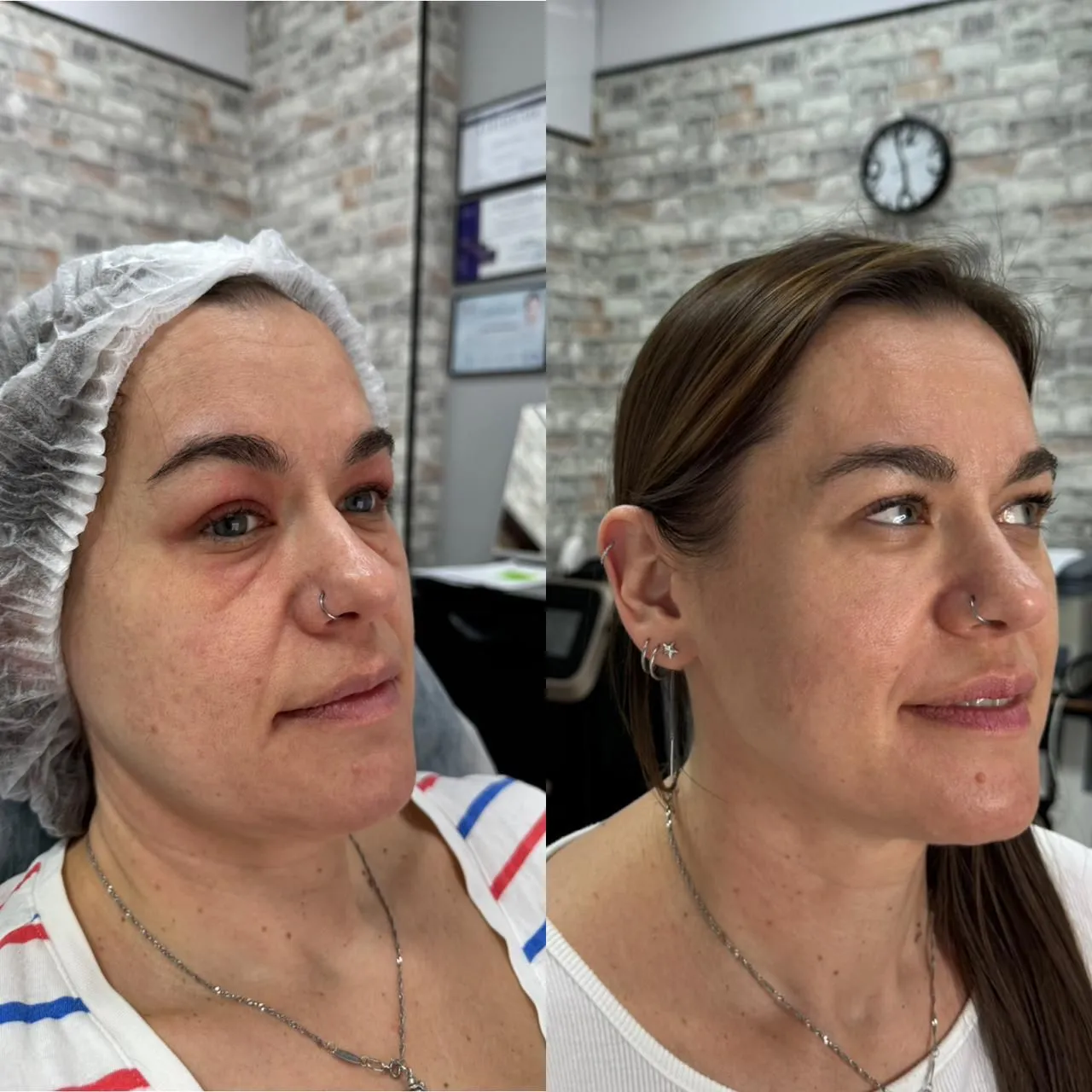 Hifu_Facial_Before_After