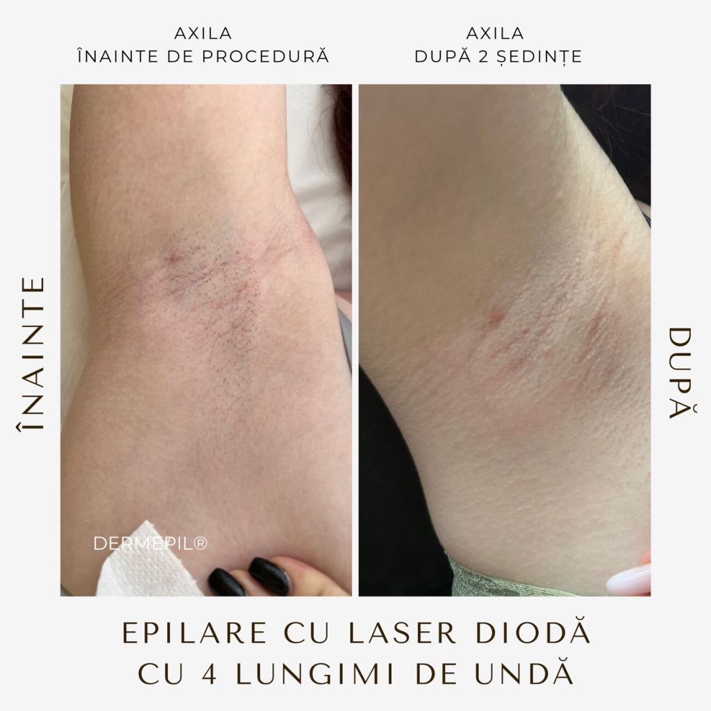 epilare-definitiva-before-and-after-2.png.jpg