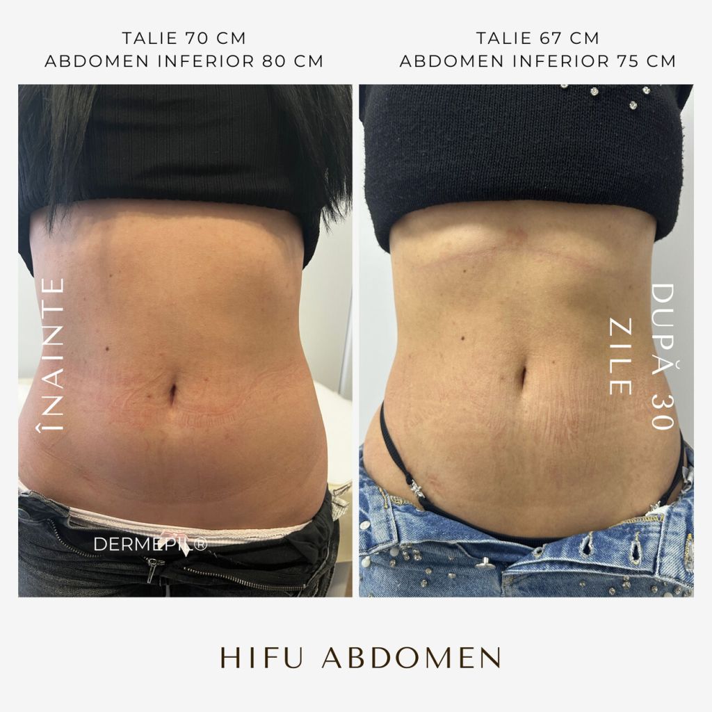 hifu-before-and-after-28.png.jpg