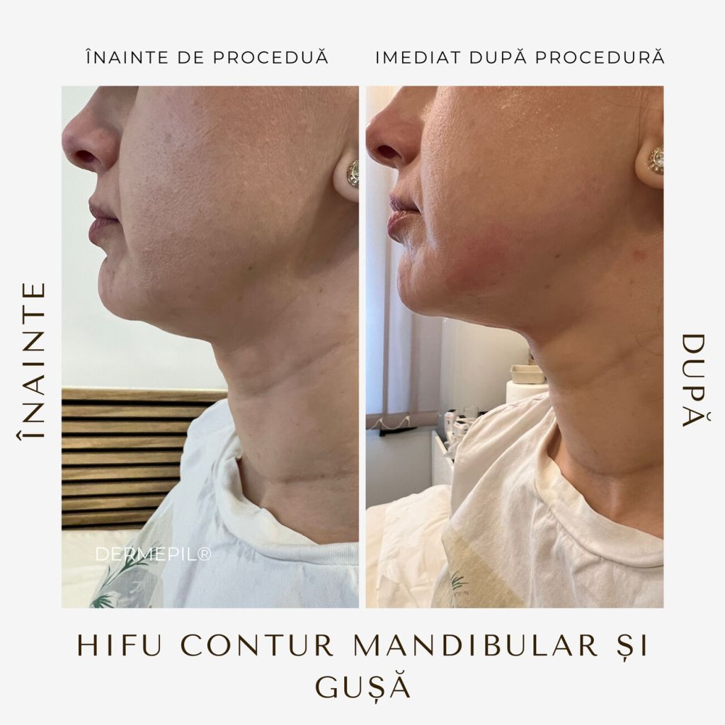 hifu-before-and-after-34.png.jpg