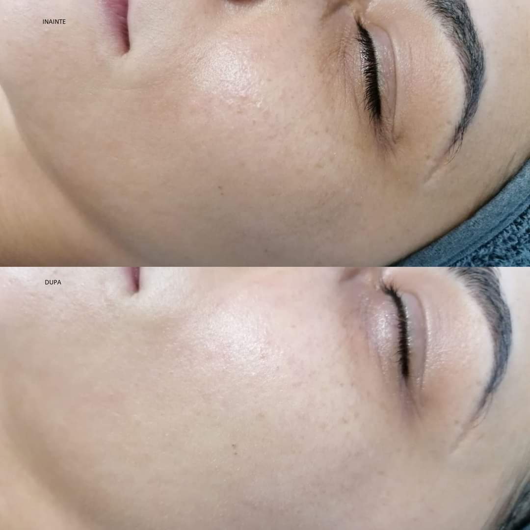 Rejuvenare Facială cu Laser Dioda