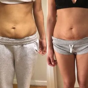 HiFU/Liposonix Lombar