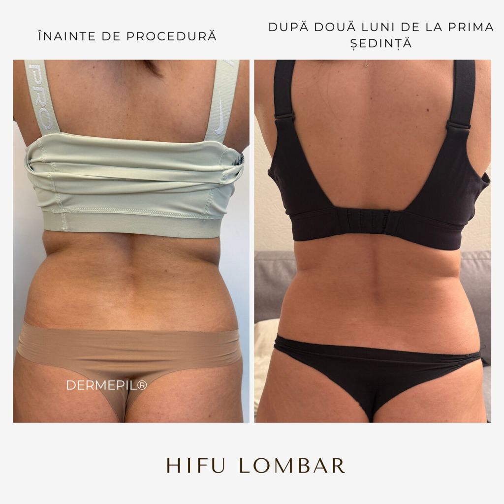 hifu-before-and-after-12.png.jpg