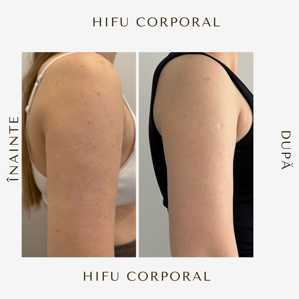 hifu-before-and-after-14.jpg