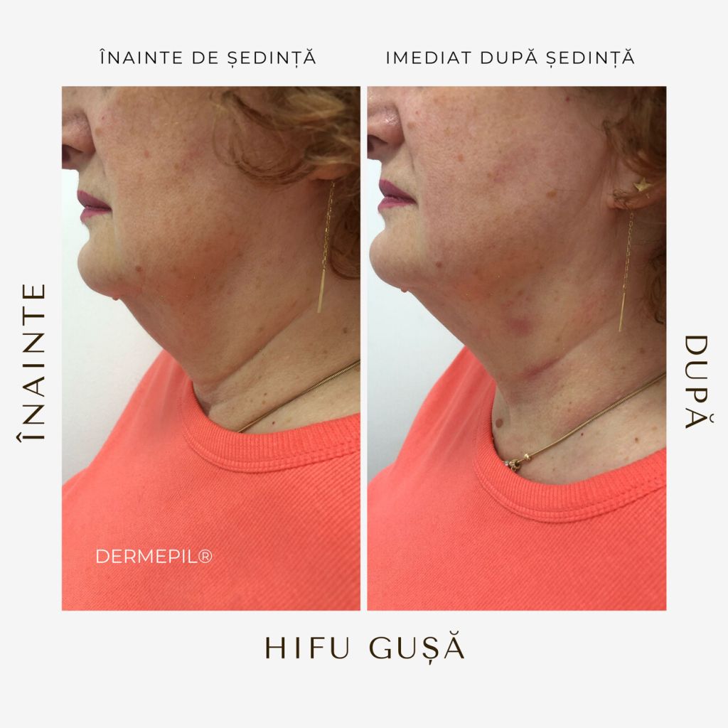 hifu-before-and-after-2.png.jpg