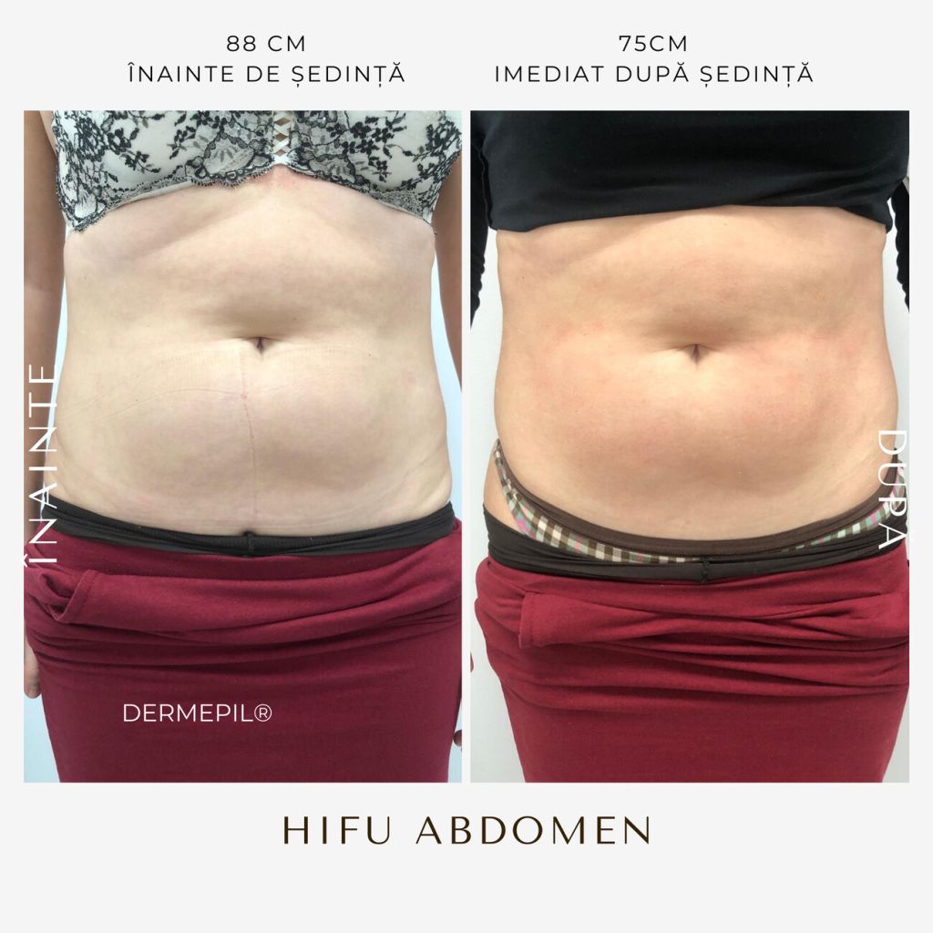 hifu-before-and-after-31.png.jpg