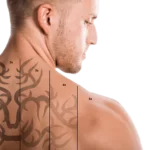 Îndepãrtare Tatuaj
