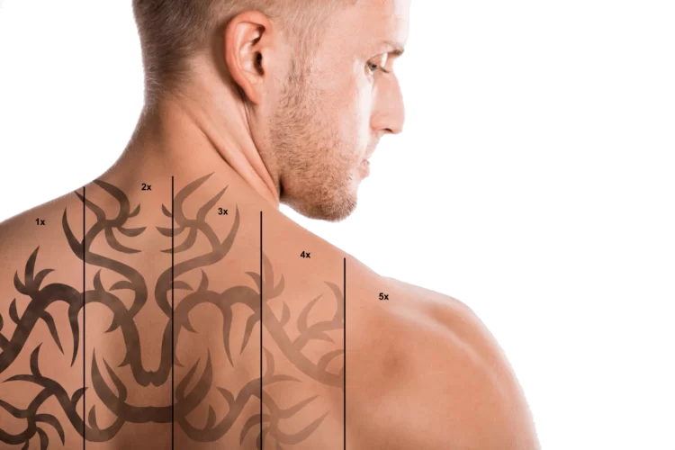 Îndepărtare tatuaj cu laser