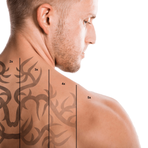 Îndepărtare tatuaj cu laser