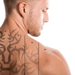 Îndepărtare tatuaj cu laser