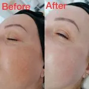 Tratament Facial cu Laser Diodă - imagine 3