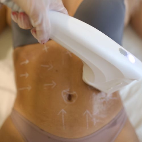 Black Friday Abonament 3 Sedinte HiFU-Abdomen