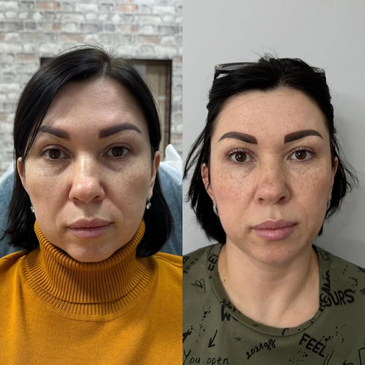 Black Friday Abonament 3 ședințe HIFU Față total+gât+mască - imagine 3