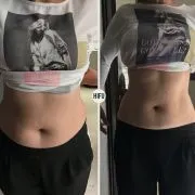 HiFu Abdomen - imagine 4