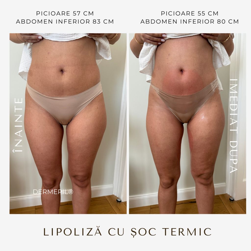 criolipoliza-before-after-4.png.jpg