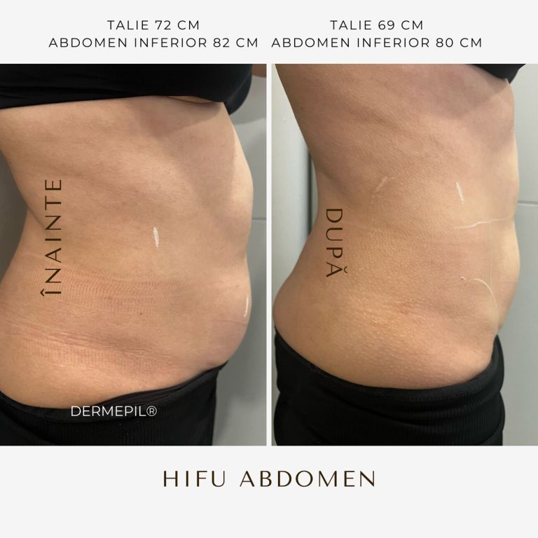 hifu-before-and-after-27.png.jpg