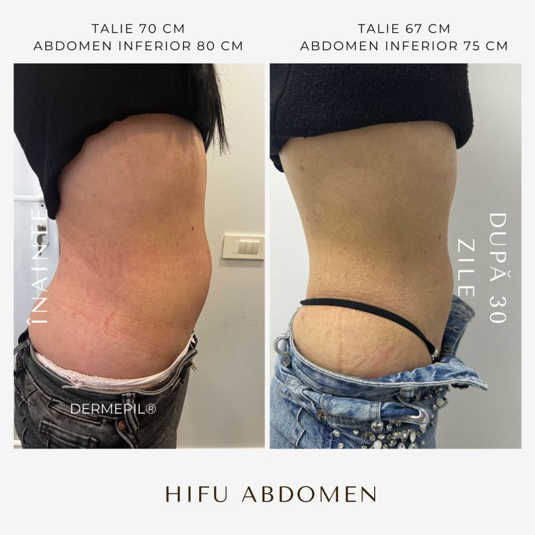 hifu-before-and-after-29.png.jpg